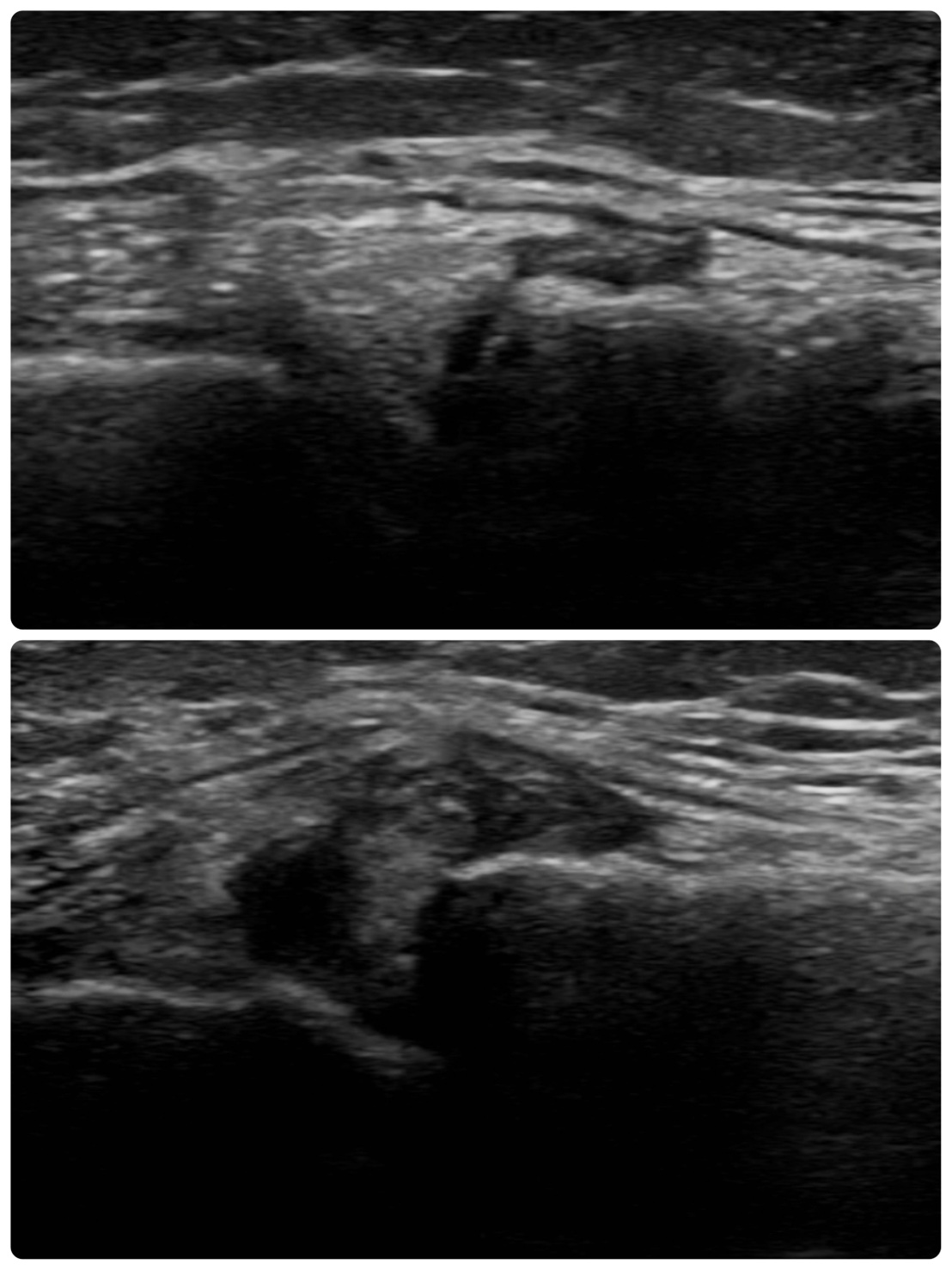 膝の痛みをエコーで観察。下画像は関節の間が腫れている様子