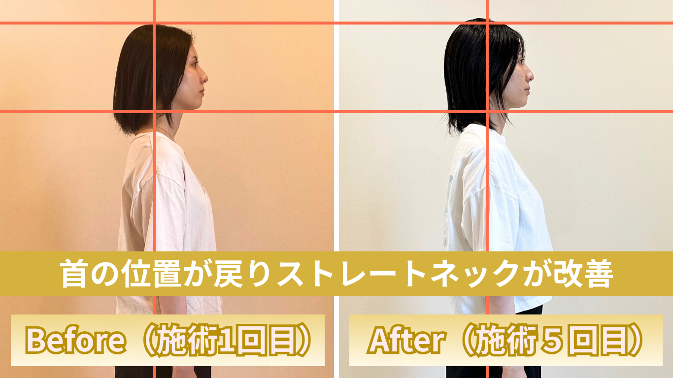 整体院omoのストレートネックビフォアフ