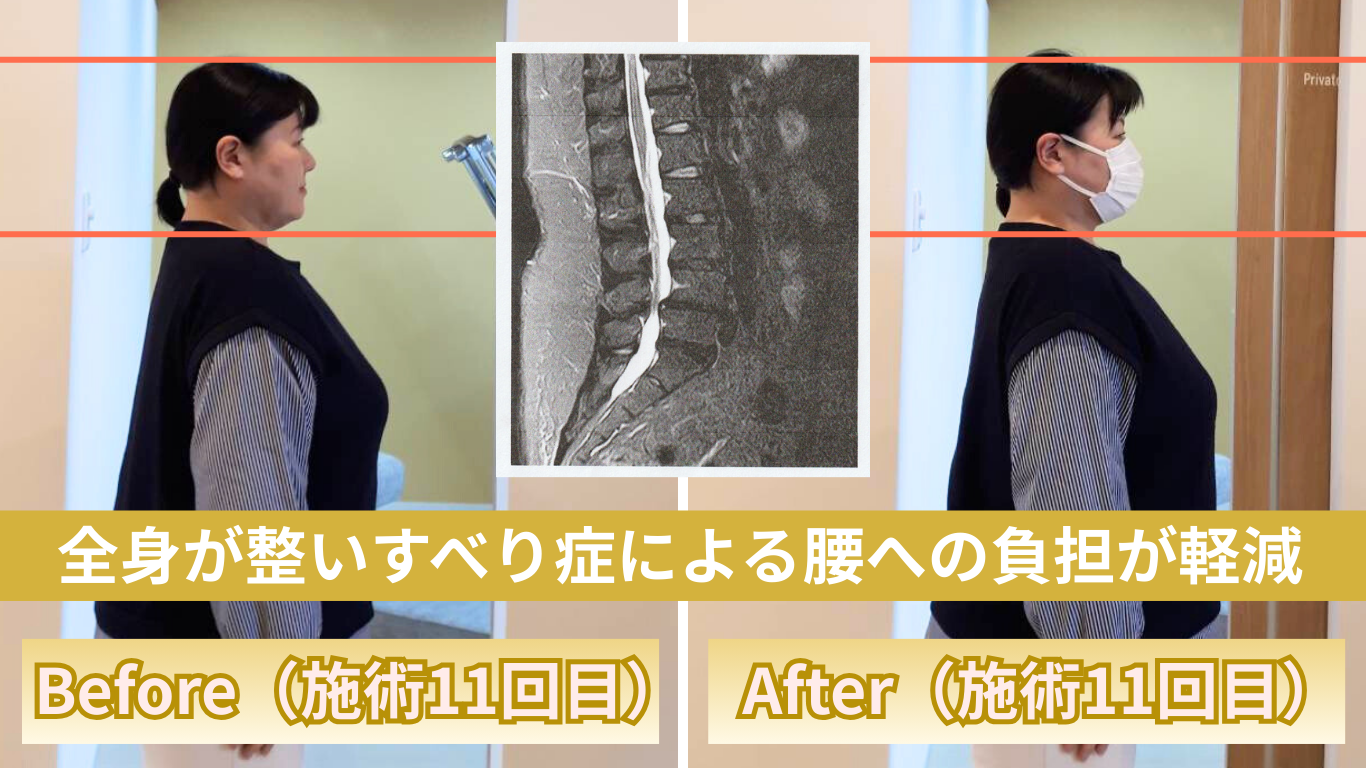 整体院omoのすべり症ビフォアフ