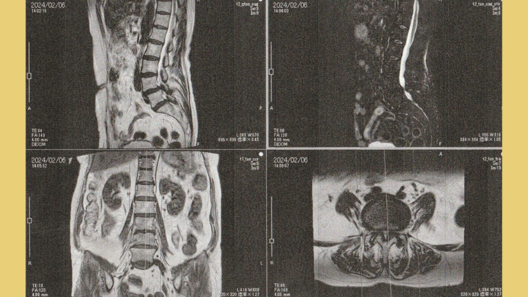 神経痛を見決めれるためのMRI