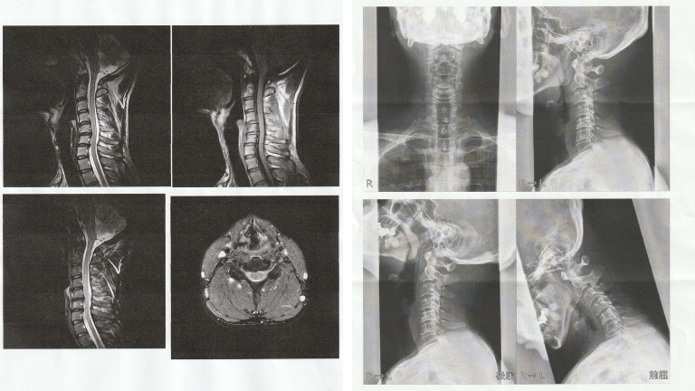 首ヘルニア・ストレートネックのMRI・レントゲン